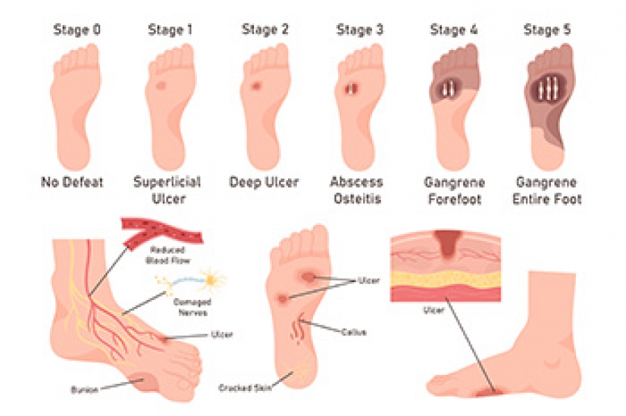 Ulcer on heel of foot discount
