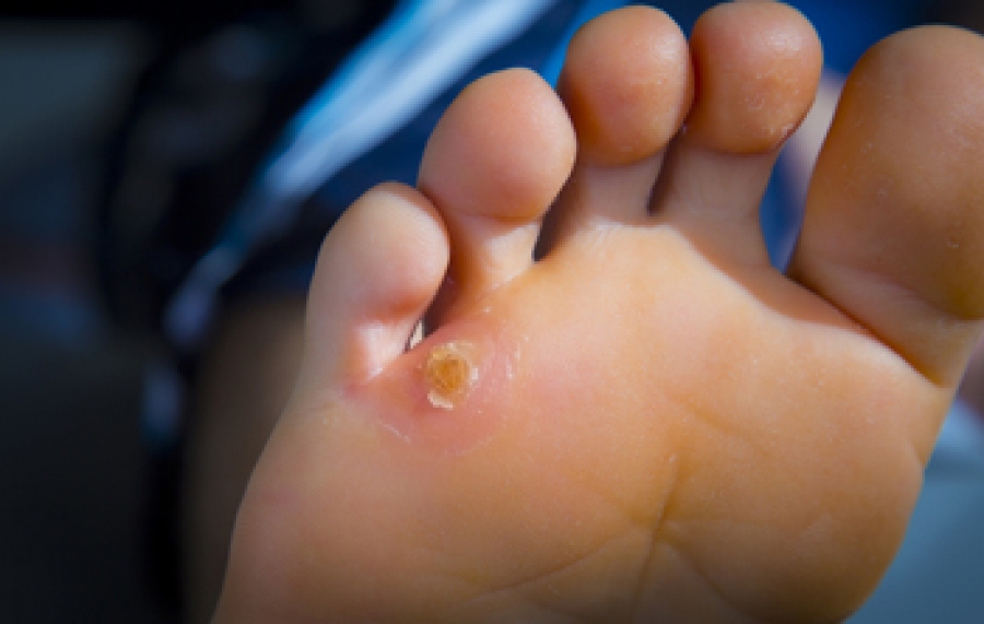 Corns Can Be Painful and Relief Is Often Sought