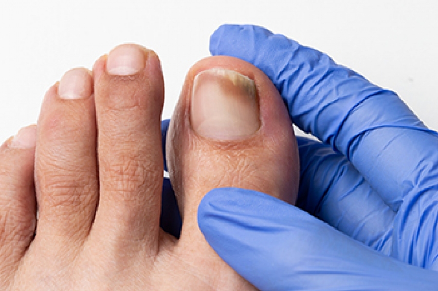 5 home remedies to get rid of fungal infection in toenails.- पैर के नाखूनों  में फंगल इन्फेक्शन का उपचार कर सकती हैं ये 5 होम रेमेडीज। | HealthShots  Hindi