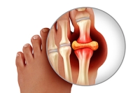 How a Podiatrist Diagnoses Gout