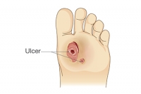 The Progression of Foot Ulcer Stages