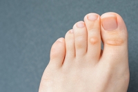 Foot Corns and Podiatric Care